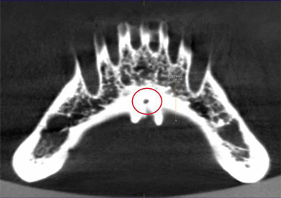 بررسی تغییرات آناتومیکی سوراخ لینگوال و کانال‌های استخوانی با CBCT