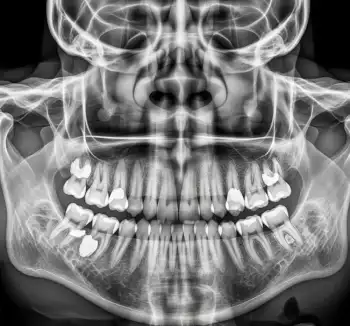 ارزیابی رادیوگرافیک خطرات جراحی سینوس فک بالا در کاندیداهای سینوس لیفت با استفاده از CBCT