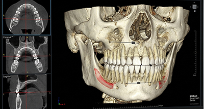 دقت هوش مصنوعی در شناسایی و بخش‌بندی ساختارهای دهان و فک و صورت با استفاده از تصاویر CBCT
